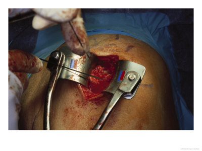 Surgery Of The Shoulder by Scott Shapiro Pricing Limited Edition Print image
