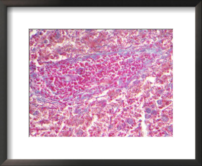 Anthrax, Bacillus Anthracis & Red Infected Cells In Animal Tissue by Kent Wood Pricing Limited Edition Print image