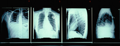 X-Rays Of Human Chest by Panoramic Images Pricing Limited Edition Print image