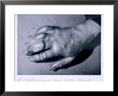 Dr. Atkinson's Frost-Bitten Hand, 1911 by Herbert Ponting Pricing Limited Edition Print image