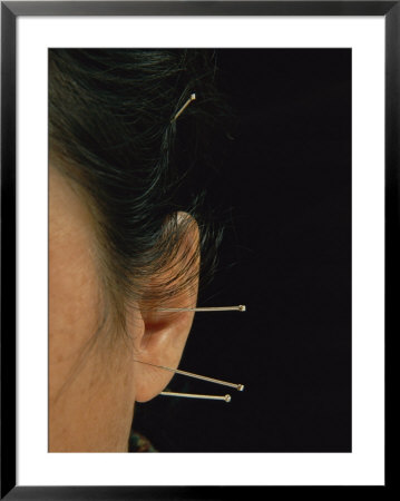 Close View Of Woman Receiving Acupuncture Treatment Around Her Ears by O. Louis Mazzatenta Pricing Limited Edition Print image