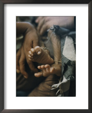 Close View Of The Twisted Feet Of A Starving Child by W. E. Garrett Pricing Limited Edition Print image