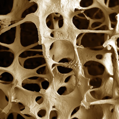 Osteoporosis From An 89-Year Old Female by Alan Boyde Pricing Limited Edition Print image