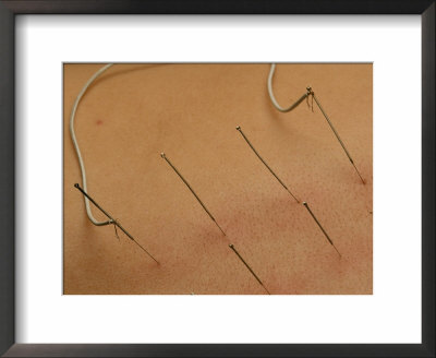 Close View Of Accupuncture Needles Treating A Stomach Ailment by O. Louis Mazzatenta Pricing Limited Edition Print image