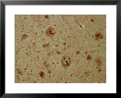 Alzheimers Disease, Bielchowsky Stain X64 by G. W. Willis Pricing Limited Edition Print image