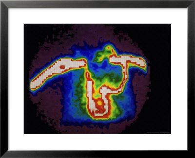 Nuclear Medicine-Gamma Camera Scan Showing Occlusion Of Venacava, Heart In Lower Center by David M. Dennis Pricing Limited Edition Print image