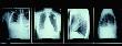 X-Rays Of Human Chest by Panoramic Images Limited Edition Pricing Art Print