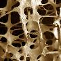 Osteoporosis From An 89-Year Old Female by Alan Boyde Limited Edition Print